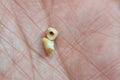 Deciduous primary baby temporary teeth, the first set of teeth in the growth and development of humans, They are usually lost and
