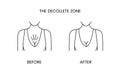 The decollete zone, laser cosmetology before procedure and after applying treatment line icon in vector. Illustration of