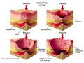 Decubitus ulcer