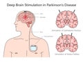 Deep brain stimulation diagram medical science