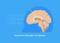 Deep brain stimulation for epilepsy or seizure