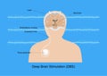 Deep brain stimulation for treatment of parkinson disease