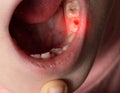 Deep caries in children on milk teeth. Treatment of caries, toothache. Baby teeth, macro