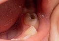 Deep caries in children on milk teeth. Treatment of caries, toothache. Baby teeth, macro