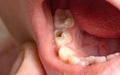 Deep caries in children on milk teeth. Treatment of caries, toothache. Baby teeth, macro