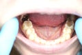 Deep caries, open canals, cleaning canals. Patient at stomatolon on admission, periodontitis treatment