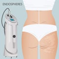 Deep cellulite reduction Body contouring Lifting with Endospheres apparatus. Physiotherapy, lymphatic Royalty Free Stock Photo