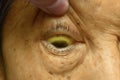 Deep jaundice in Asian female patient. Yellowish discoloration of skin and sclera. Hyperbilirubinemia