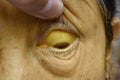 Deep jaundice in Asian female patient. Yellowish discoloration of skin and sclera. Hyperbilirubinemia