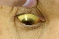 Deep jaundice in Asian male patient. Yellowish discoloration of skin and sclera. Hyperbilirubinemia