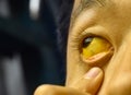 Deep jaundice in Asian male patient. Yellowish discoloration of skin and sclera. Hyperbilirubinemia