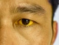 Deep jaundice in Asian male patient. Yellowish discoloration of skin and sclera. Hyperbilirubinemia