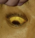 Deep jaundice in Asian male patient. Yellowish discoloration of skin and sclera. Hyperbilirubinemia