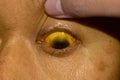 Deep jaundice in Asian male patient. Yellowish discoloration of skin and sclera. Hyperbilirubinemia