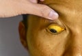 Deep jaundice in Asian male patient. Yellowish discoloration of skin and sclera. Hyperbilirubinemia