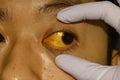 Deep jaundice in Asian male patient. Yellowish discoloration of skin and sclera. Hyperbilirubinemia