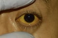 Deep jaundice in Asian male patient. Yellowish discoloration of skin and sclera. Hyperbilirubinemia