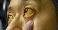 Deep jaundice in Asian male patient. Yellowish discoloration of skin and sclera. Hyperbilirubinemia