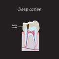 Deep tooth decay. Vector illustration on a black