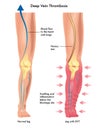 Deep vein thrombosis