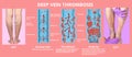 Deep Vein Thrombosis or Blood Clots. Embolus.