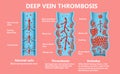 Deep Vein Thrombosis or Blood Clots. Embolus