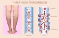 Deep Vein Thrombosis or Blood Clots. Embolus.