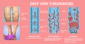 Deep Vein Thrombosis or Blood Clots. Embolus.