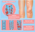 Deep Vein Thrombosis or Blood Clots. Embolus.