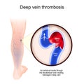 Deep Vein Thrombosis. Close-up of blood vessel with blood clot