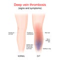 Deep vein thrombosis. Healthy leg, and leg with DVT. Sign and symptoms