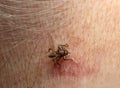 Deer fly, Lipoptena cervi biting on human neck Royalty Free Stock Photo