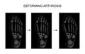 Deforming arthrosis of the foot