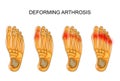 Deforming arthrosis of the foot Royalty Free Stock Photo