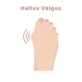 Deformity bunion bone of toe - Hallux valgus. Orthopedic disease
