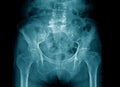 Degeneration lumbosacral spine x-ray image Royalty Free Stock Photo