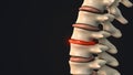 Degenerative disc in the human spine