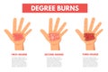 Degree burns of skin. Infographic Royalty Free Stock Photo