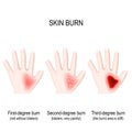 Degree burns of skin. step of burn