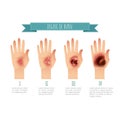Degree of skin burns. Flat vector illustration for websites, brochures, magazines etc Royalty Free Stock Photo