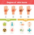 Degree of skin burns. Vector. Royalty Free Stock Photo