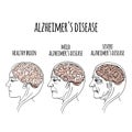 DEMENTIA Alzheimer Disease Medicine Vector Illustration Royalty Free Stock Photo