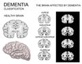 Dementia, Alzheimer's disease Royalty Free Stock Photo