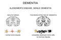 Dementia, Alzheimer s disease. pathogenesis Royalty Free Stock Photo