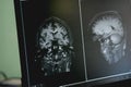 Dementia on MRI film. brain dementia.