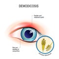 Demodicosis of eyelid and red eyes. Close-up demodex through mag