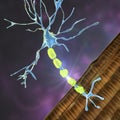 Demyelination of a neuron, the damage of the neuron myelin sheath seen in demyelinating diseases Royalty Free Stock Photo