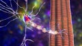 Demyelination of neuron, the damage of the neuron myelin sheath seen in demyelinating diseases Royalty Free Stock Photo