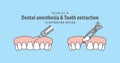 Dental anesthesia,a syringe injecting to gums & Tooth extraction,tooth removal by forceps illustration vector design on blue