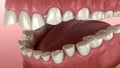 Dental attrition Bruxism resulting in loss of tooth tissue. Medically accurate tooth 3D animation